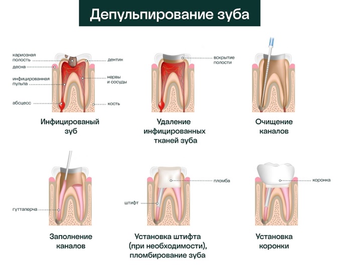 депульпирование зуба